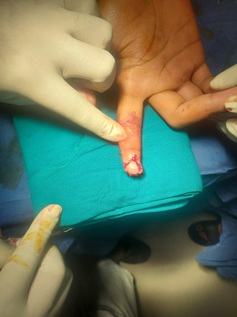 hand surgery (flap) in Mandi HP